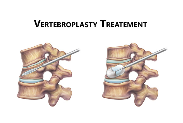 Vertebroplasty