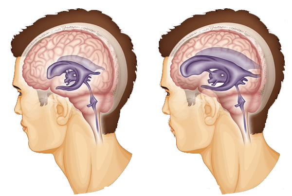 Hydrocephalus