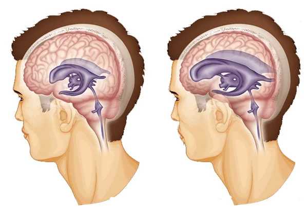 Hydrocephalus