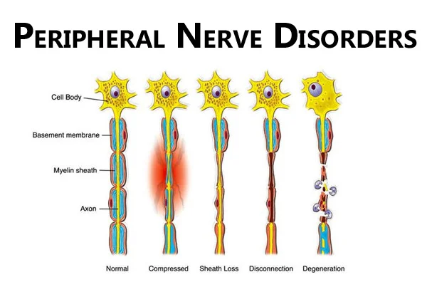 Peripheral Nerve Disorders